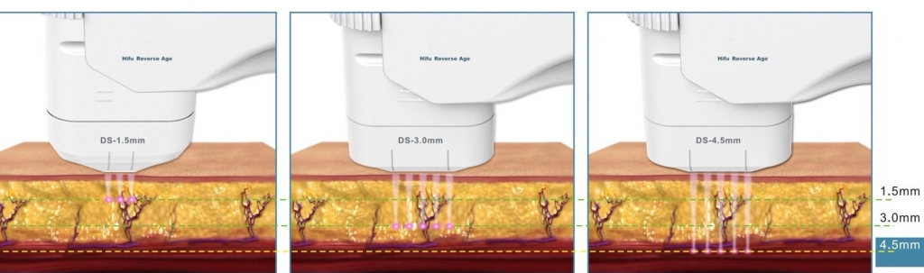 UltraLift hifu